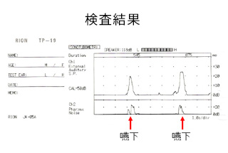 聴力図