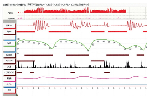 アプノモニター検査データ