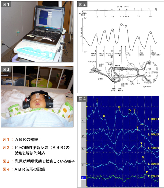 「ABR検査」図1：ABRの器械、図2：ヒトの聴性脳幹反応（ABR）の波形と解剖的対応、図3：乳児が睡眠状態で検査している様子、図4：ABR波形の記録