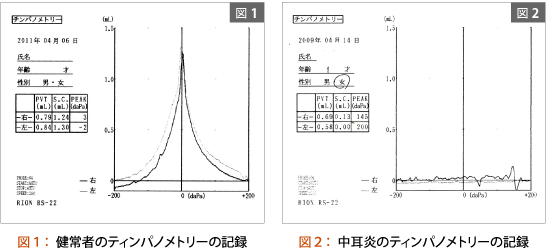 ティンパノメトリー検査